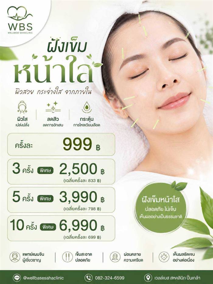 ฝังเข็มหน้าใส